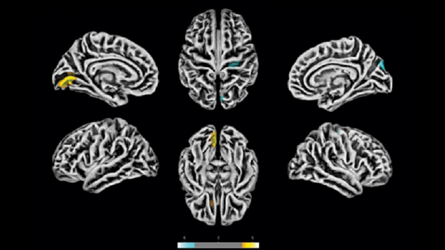 Exames de ressonância magnética feitos na Unicamp em 81 pacientes com sintomas neuropsiquiátricos pós-covid revelam alterações na estrutura do córtex cerebral. As áreas em amarelo apresentam redução na espessura cortical. As marcas azuis correspondem a áreas com espessura aumentada - Reprodução/medRxiv
