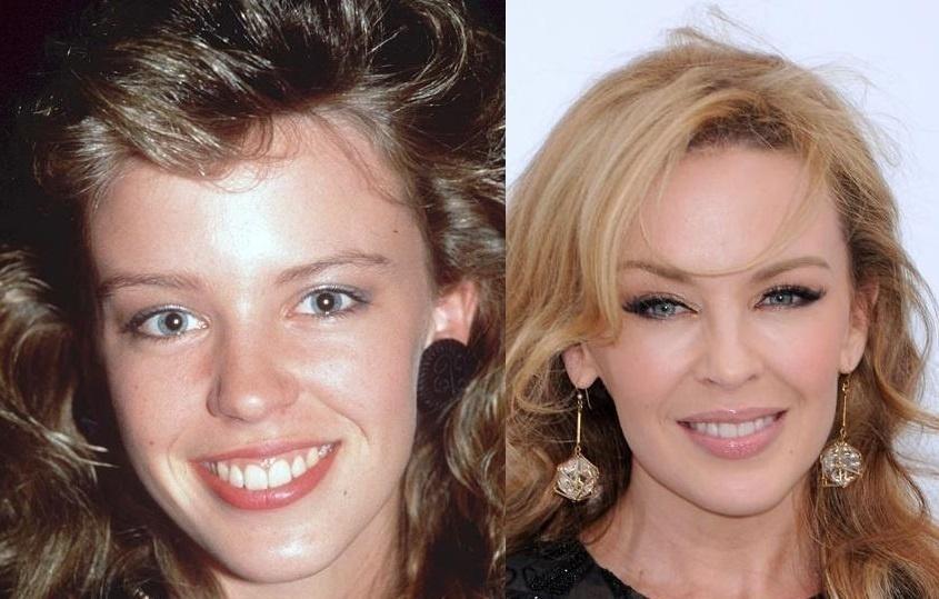 Antes e depois de Kylie Minogue - Montagem/Reprodução