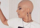 Cabeleireira fica careca após diagnóstico de alopecia: 