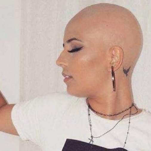 Dançarina com alopecia abandona peruca e inspira outras mulheres