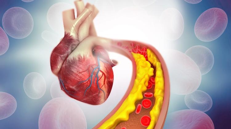 Infarto ocorre, em geral, por obstrução das artérias que irrigam o coração Infarto ocorre, em geral, por obstrução das artérias que irrigam o coração