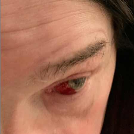 Ozzy Osbourne machuca o olho após tossir - Reprodução