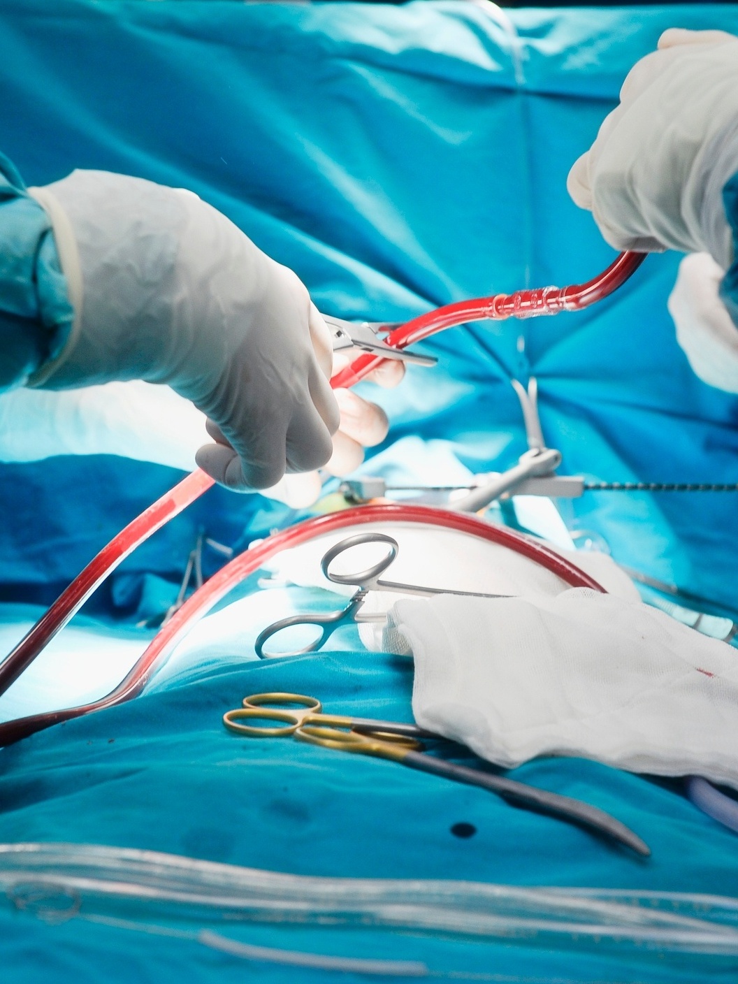 Brasil tem fila de 60 mil pessoas à espera de cirurgias cardiovasculares -  30052021 - UOL VivaBem