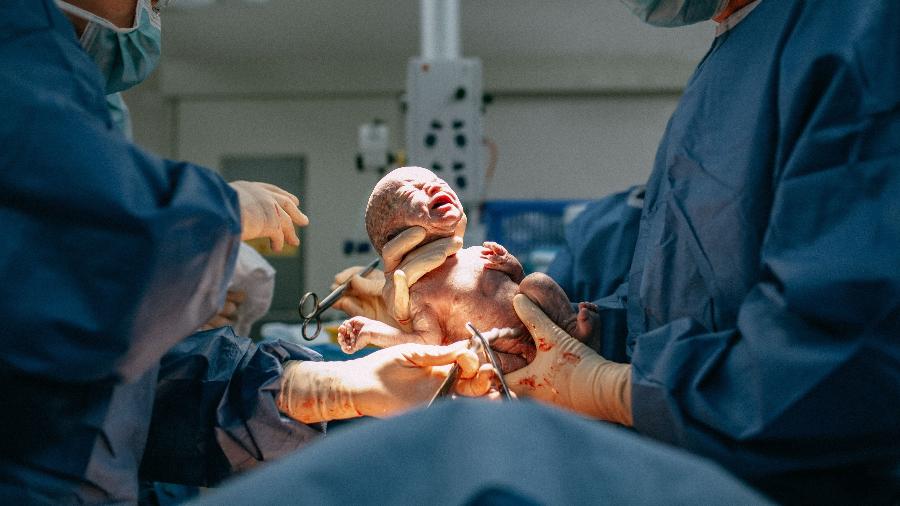 Parto cesárea não é o mais indicado para a maioria das mulheres - Getty Images