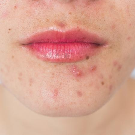 Remédio é utilizado para tratamento de redução das acnes na pele - Boyloso/iStock