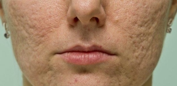 Espremer espinhas pode causar inflamações que deixam cicatrizes na pele - Thinkstock Images - Thinkstock Images