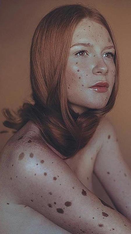 A espanhola Alejandra Savoia nasceu com o corpo repleto de manchas marrons - Reprodução/Instagram
