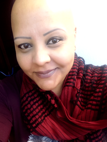 A auxiliar jurídica Juliana Fernandes tem alopecia areata - Arquivo pessoal