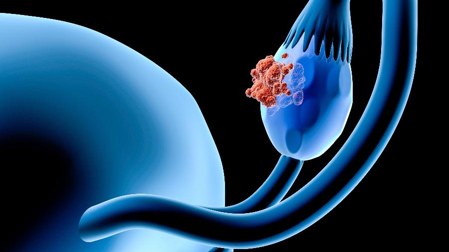 Composto de paládio teve elevada eficiência frente à linhagem de células tumorais de ovário resistentes à cisplatina, composto à base de platina usado na quimioterapia - Getty Images