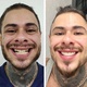 Leo Stronda mostra o antes e o depois de lentes de contato nos dentes - Reprodução/Instagram