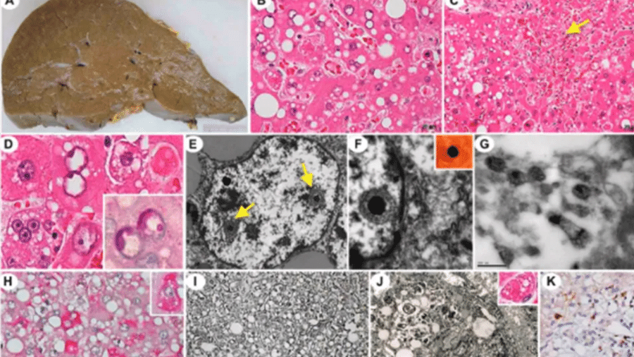 Patologia da infecção grave pelo SABV. Imagens mostram fígado danificado e detalhes do vírus - Assessoria de Comunicação da FMUSP