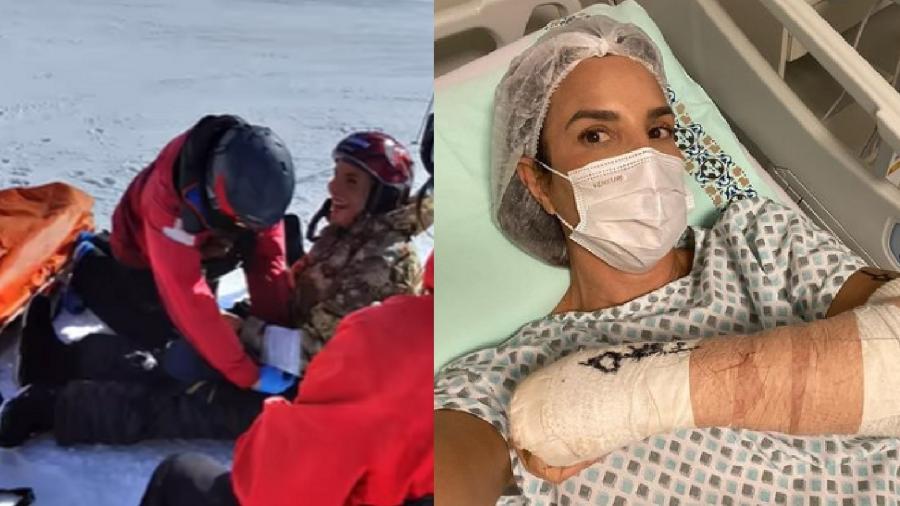 Ivete Sangalo no Chile (à esquerda) e após cirurgia (à direita) - Reprodução/Instagram