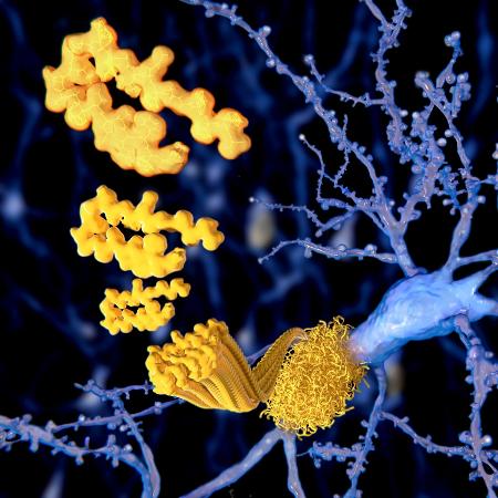 Grandes quantidades de beta-amiloide pode ser sinal do Alzheimer - iStock
