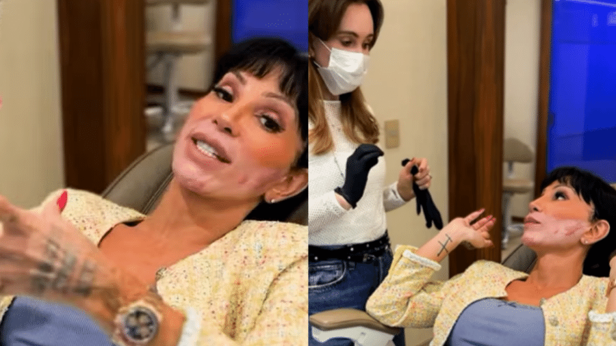 Maya Massafera, que passou pela transição de gênero, mostra rosto manchado Maya Massafera, que passou pela transição de gênero, mostra rosto manchado
