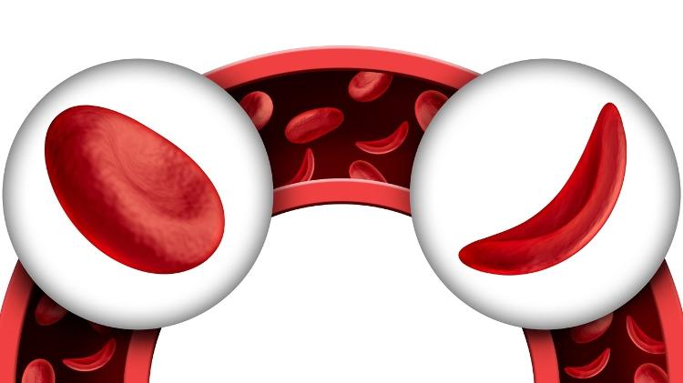 Anemia falciforme - iStock - iStock