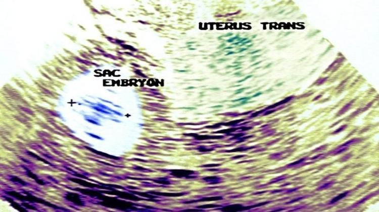 O ultrassom é um dos métodos para detectar gestações ectópicas - GETTY IMAGES - GETTY IMAGES