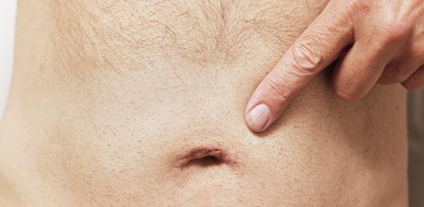 Do you clean your belly button?  Dirt can cause irritation and even serious infection