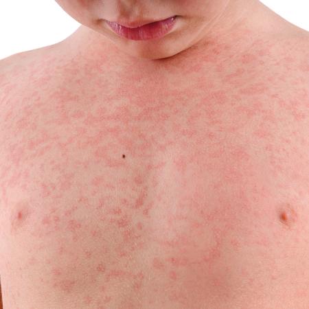 Um dos sintomas da síndrome de Kawasaki é o aparecimento de "rash curtâneo", com lesões que forma placas avermelhadas na pele - iStock