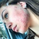 Flávia Pavanelli mostra espinhas no rosto, antes de fazer tratamento - Reprodução/Instagram