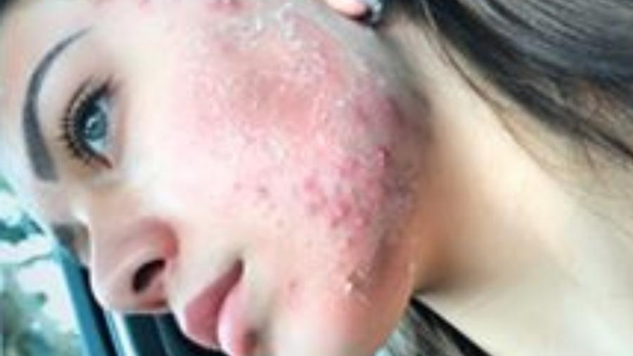 Flávia Pavanelli mostra espinhas no rosto, antes de fazer tratamento - Reprodução/Instagram