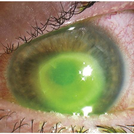 Contaminação por protozoário pode causar infecção e perda da visão - Reprodução/The New England Journal of Medicine 