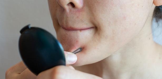 Sofre com acne adulta? Veja produtos que podem ajudar a suavizar espinhas