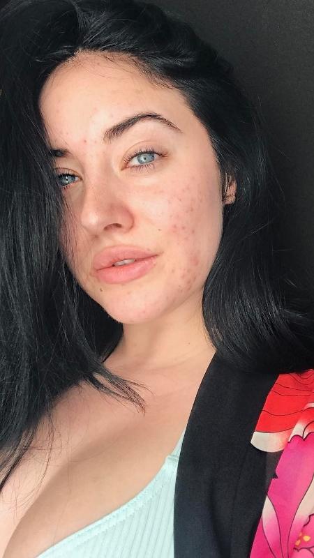 A modelo e cantora Starlie Smith, que desabafou na internet sobre ter acne - Reprodução/Instagram