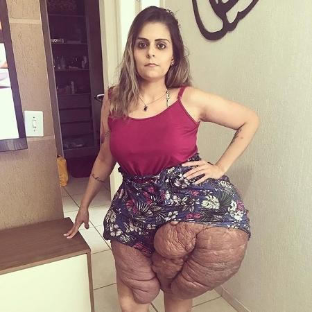 Karina Rodini - Reprodução Instagram/@superandoaneurofibromatose - Reprodução Instagram/@superandoaneurofibromatose