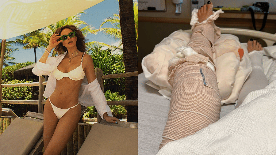 Luciana Gimenez mostra perna enfaixada após acidente - Divulgação