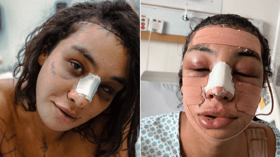 Linn da Quebrada faz procedimento de feminilização facial - Reprodução/Instagram
