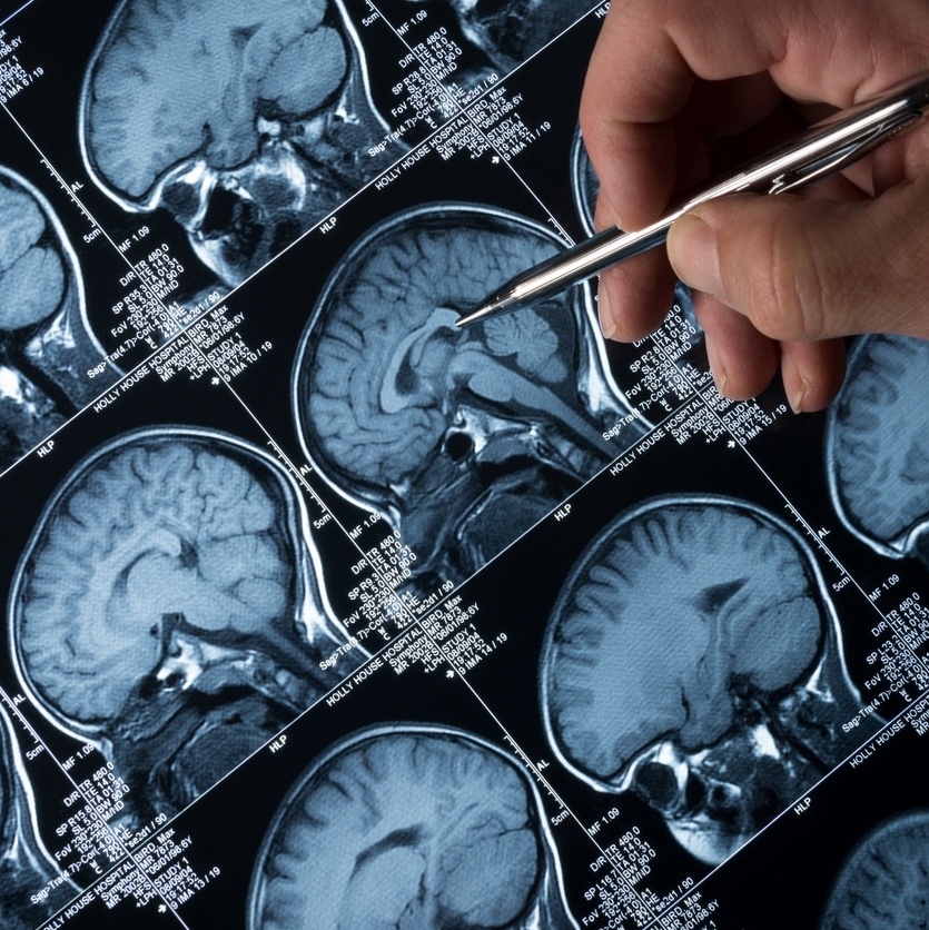 Epilepsia sem preconceito: os cuidados com pacientes nas fases