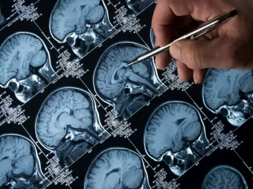 Garoto recebe 1º implante cerebral contra epilepsia do mundo