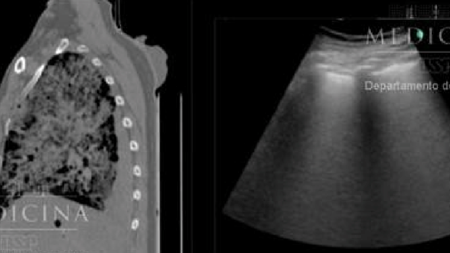 A tomografia computadorizada do tórax mostra sinais de pneumonia viral (ramificações esbranquiçadas) - Departamento de Patologia/FM-USP
