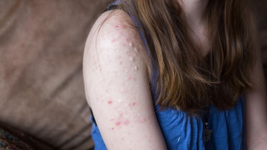 Remédio para acne diminui a produção de glândulas sebáceas; efeitos colaterais são pele, olhos e boca secas - Barcroft Media/Colaborador Getty Images