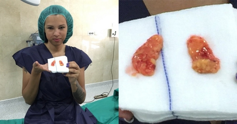 2.jul.2015 - A ex-BBB Ariadna realizou um procedimento cirúrgico e mostrou o resultado em fotos no seu Instagram na madrugada desta quinta-feira