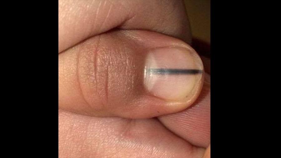 Uma americana descobriu um câncer após ir à manicure - Reprodução/Facebook