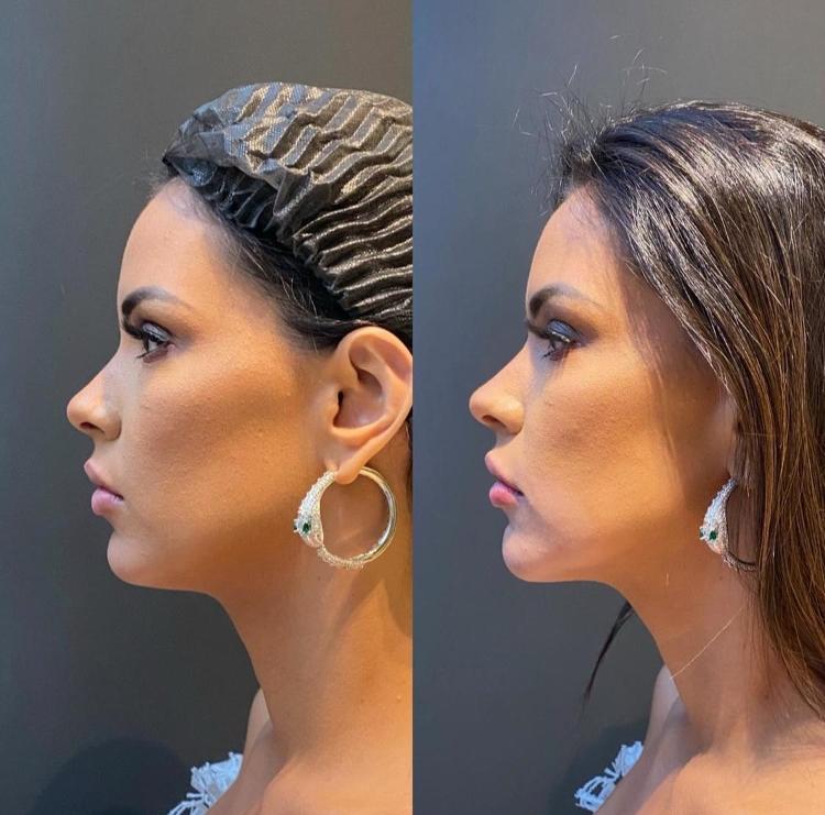 Ivy Moraes antes e depois de procedimentos estéticos - Divulgação - Divulgação