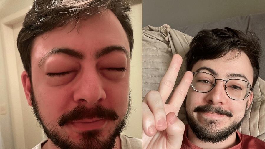 Jovem com angiodema alérgico depois de comer camarão (à esquerda) e um dia após a reação (à direita) - Reprodução/Twitter