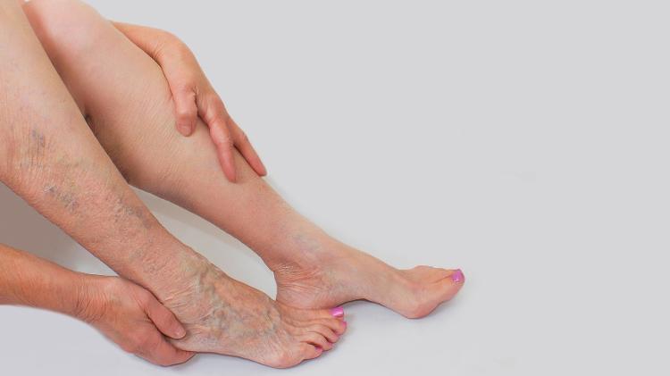 Female legs with varicose veins - iStock - iStock