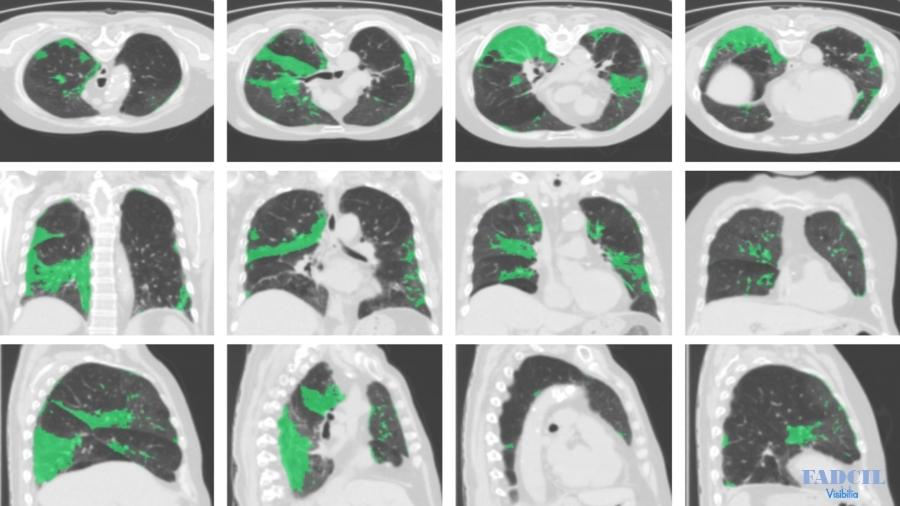 Tomografia computadorizada com lesões de Covid-19 identificadas por sistema da Visibilia - Divulgação