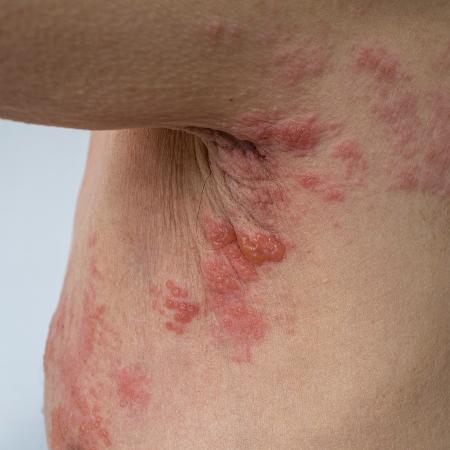 Herpes zoster causa feridas dolorosas pelo corpo - iStock