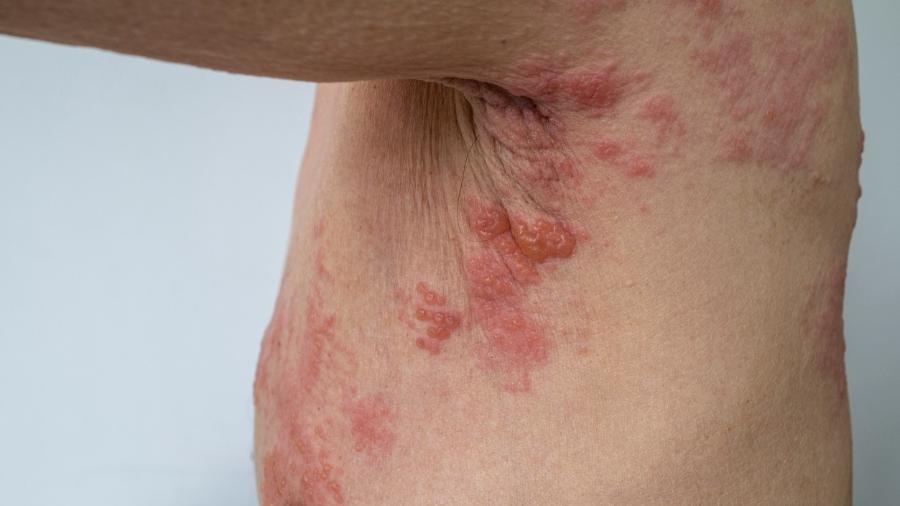 O cobreiro é o principal problema gerado pelo vírus herpes-zóster, mas ele pode provocar várias outras complicações - iStock