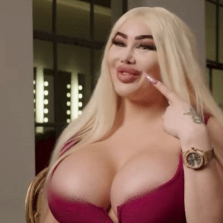 Holandesa diz que 'bumbum brasileiro' custou R$ 2 mi e quase a matou