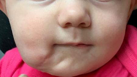 Bebe Nasce Com Duas Bocas Nos Eua Condicao E Rara E Requer Cirurgia 03 06 2020 Uol Vivabem