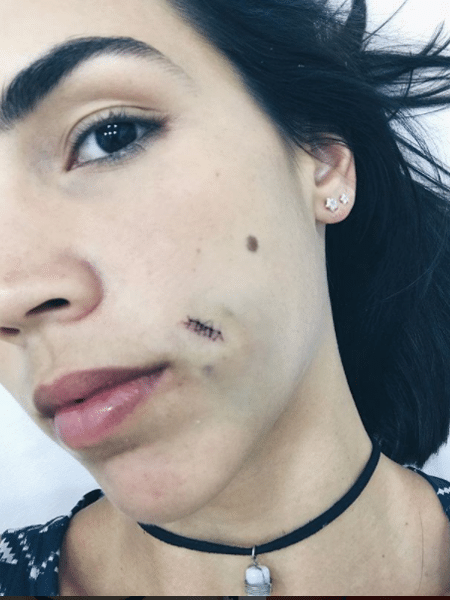 Pérola Faria mostra machucado no rosto - Reprodução/Instagram