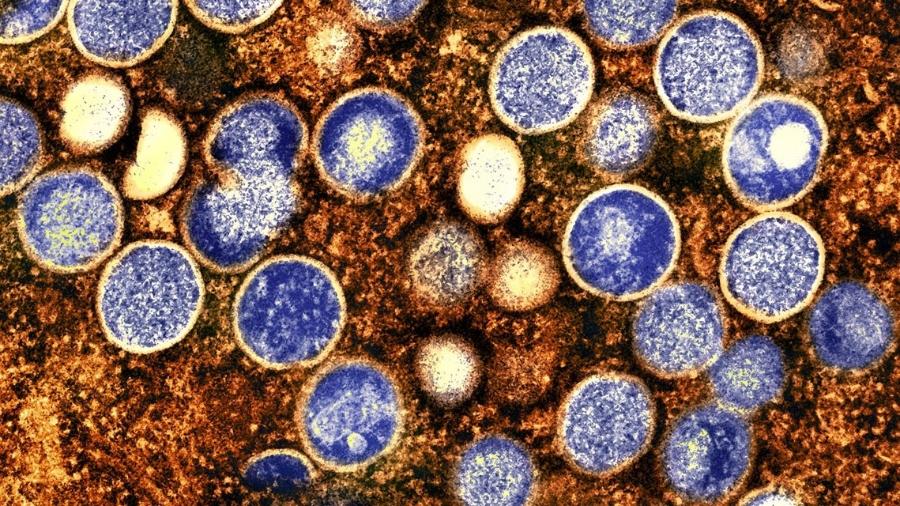 Imagem de microscopia de partículas do mpox (em azul) em células infectadas (marrom)