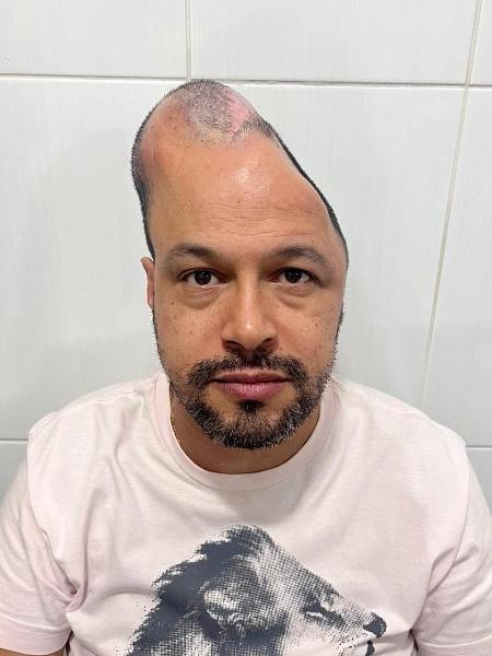 Eduardo com o expansor inflado para esticar a pele