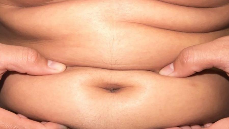O excesso de gordura pode provocar uma série de problemas de saúde - Thinkstock