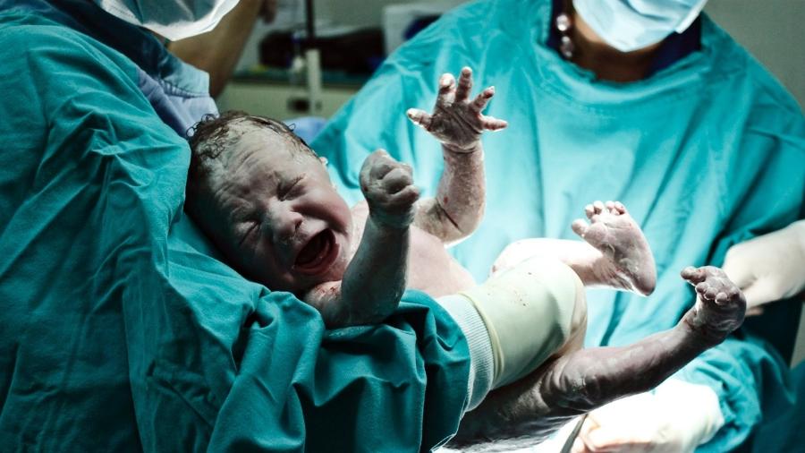 Cesárea em que a própria mãe retira o  bebê da barriga traz riscos, alertam médicos