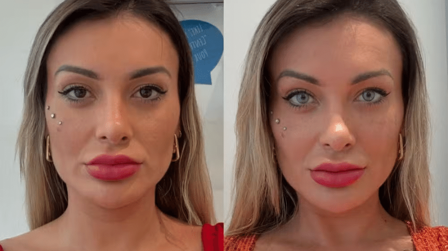 Andressa Urach faz cirurgia para mudar a cor dos olhos; veja antes e depois Andressa Urach faz cirurgia para mudar a cor dos olhos; veja antes e depois